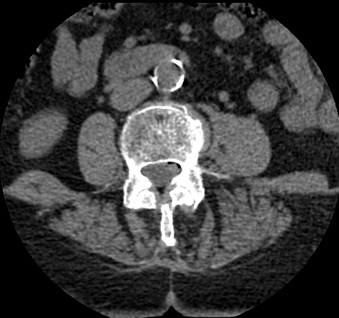 腹主动脉粥样硬化的 CT 影像。